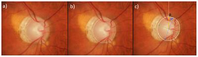 Comparison of Optic Disc Ovality Index and Rotation Angle Measurements in Myopic Eyes Using Photography and OCT Based Techniques